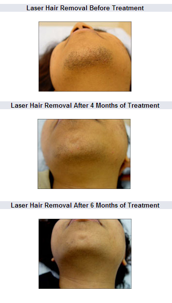 Hair Removal Treatment